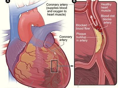 Coronary Artery Stenosis