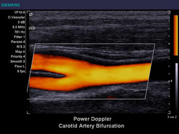 carotid ultrasound