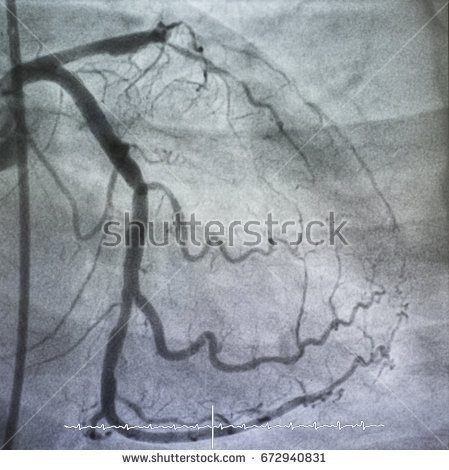 stock photo coronary angiography left coronary angiography occlusion at left anterior descending coronary 672940831