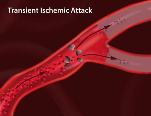 transient ischemic attack website