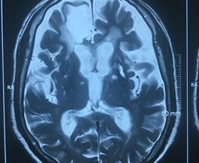 Teo não và nhồi máu vùng trán phải. BN thiều 79 tuổi