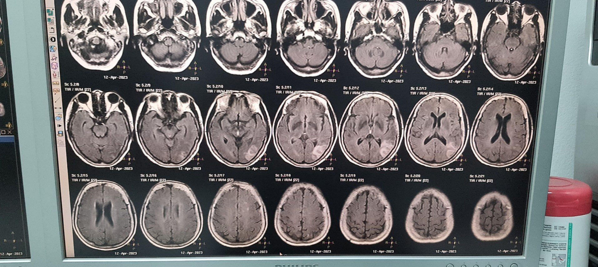 MRI nhồi máu não thái dương chẩm trái