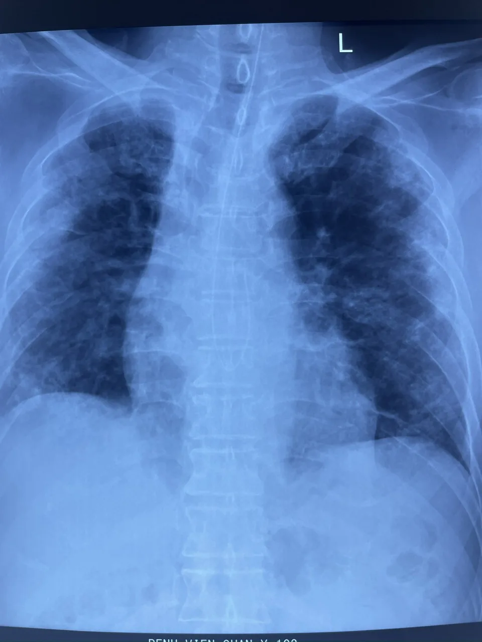 Hình ảnh viêm xơ phổi
