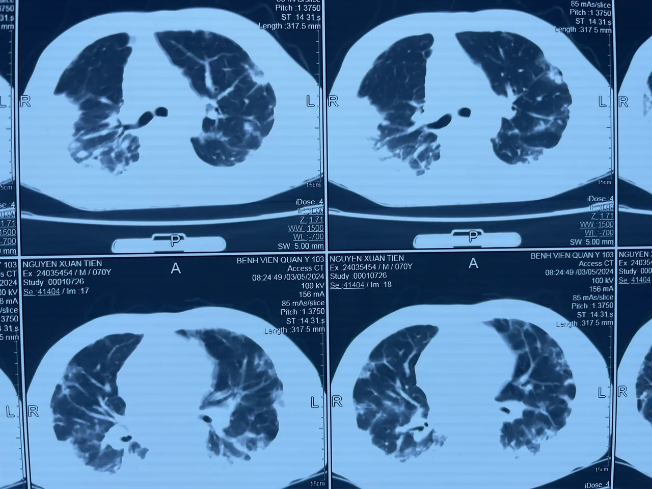 Hình ảnh viêm xơ phổi trên cắt lớp vi tính
