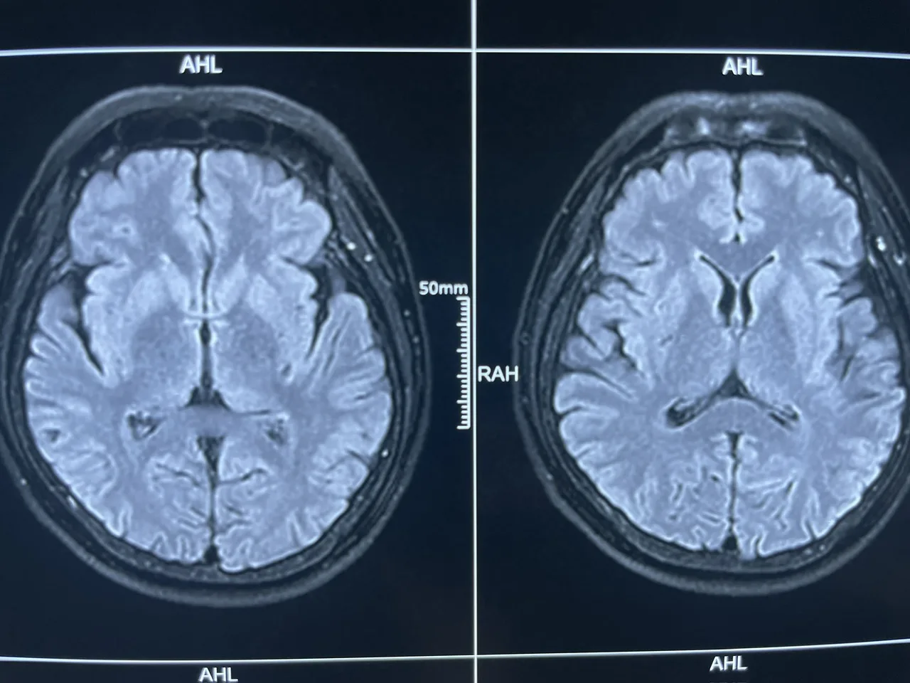 MRI so nao binh thuong jpg